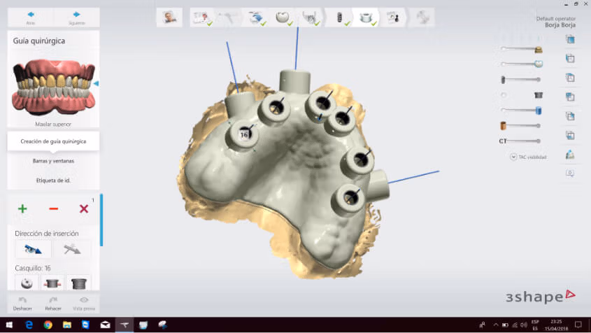 tecnología en implantes dentales