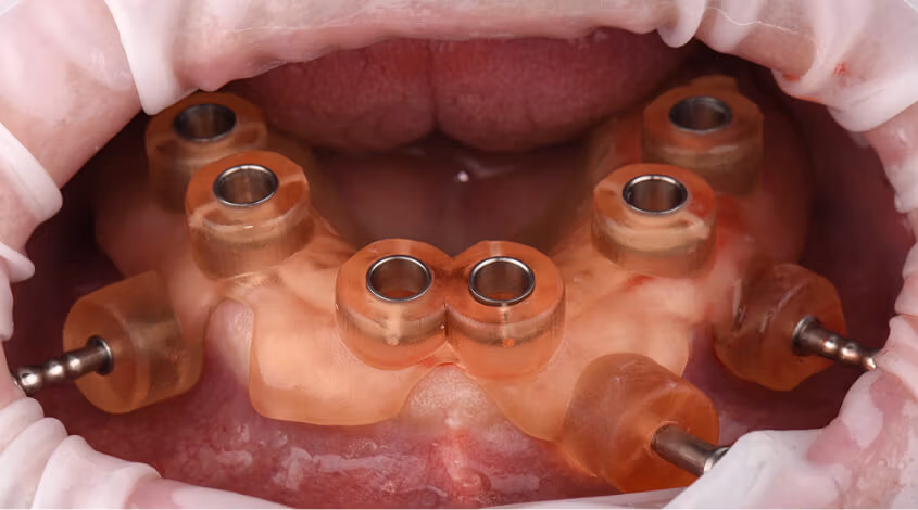cirugía de implantes dentales