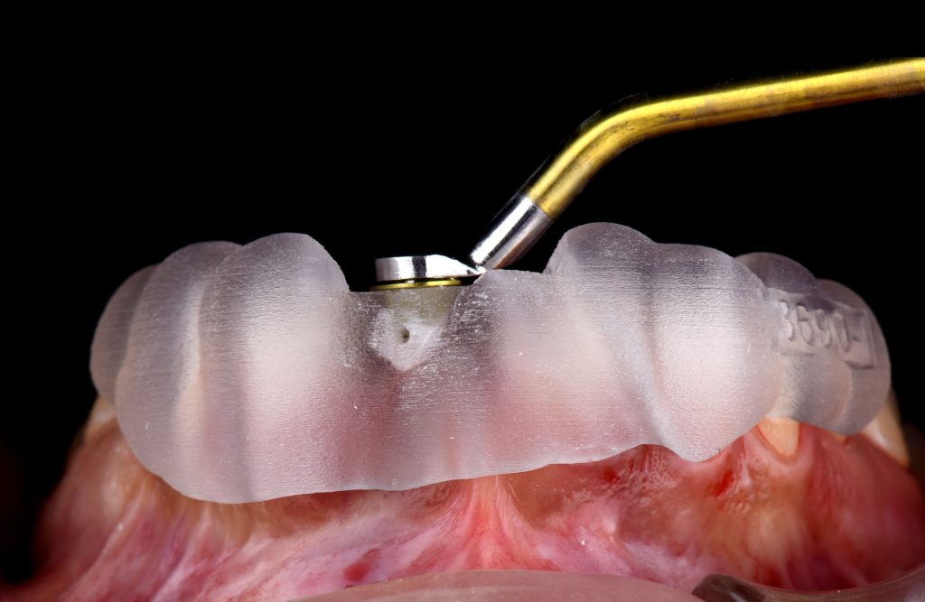 paso a paso para colocar implantes dentales
