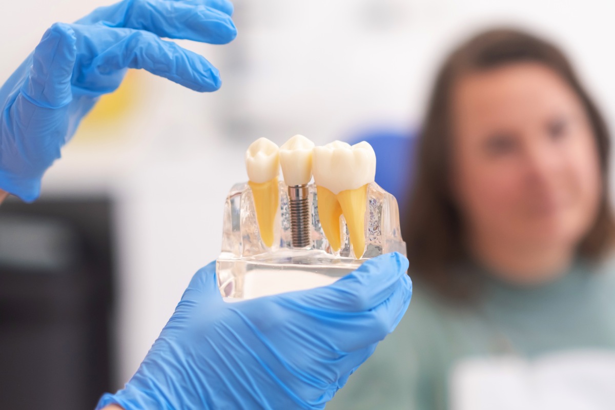 tipos de implantes dentales